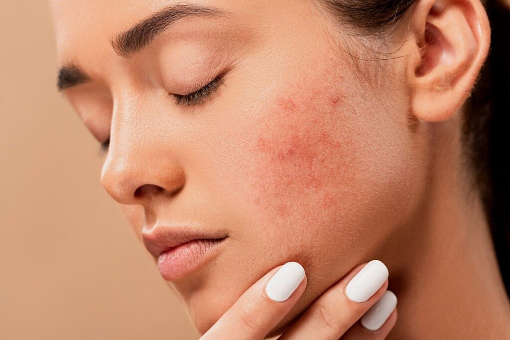 e38380e382a4e382a8e38383e38388e4b8ade381abe3838be382ade38393e3818ce381a7e3818de3828be79086e794b1e381a8e381afefbc9f ダイエット中にニキビができる理由とは?